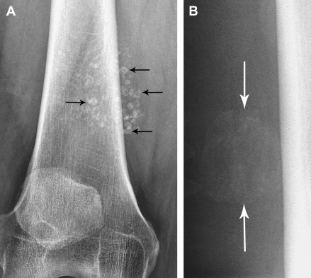 Loạn sản sụn và xương. Trẻ thường có vẻ bề ngoài thất thường, chân ngắn, tay ngắn, cổ tay, cổ chân bè, hộp sọ bất thường...