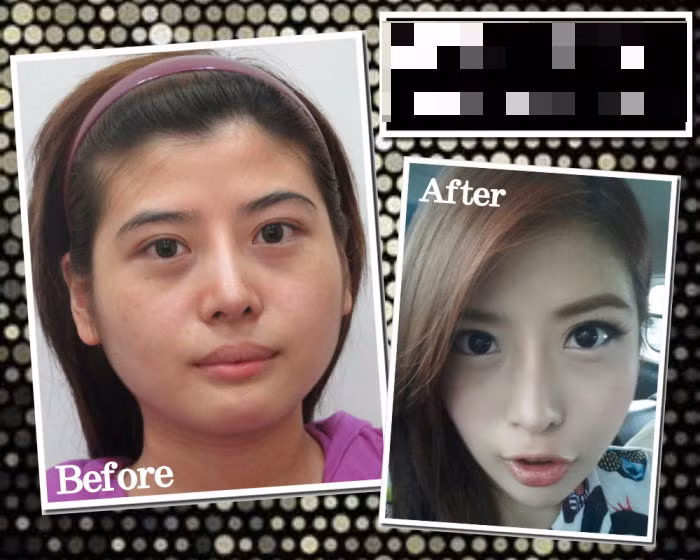 Trước khi phẫu thuật gọt mặt, cô gái có tên Dora hay bị bạn bè trêu trọc và đặt biệt danh là mặt bánh bự.