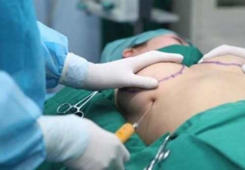 Nâng ngực không phẫu thuật bằng filler. Khác với các phương pháp thông thường khác nâng ngực không cần phẫu thuật bằng filler có sử dụng chất liệu nâng ngực như túi độn hay túi gel nâng ngực, hoặc các phương pháp nâng ngực phẫu thuật thông thường khác, nâng ngực bằng filler là cách đưa chất lỏng qua một đầu kim siêu nhỏ ,không gây đau đau đớn ,không cần gây mê ,không để lại sẹo và bạn có thể phục hồi sinh hoạt bình thường sau khi thủ tục kết thúc. Tùy thuộc vào độ hấp thu của cơ thể đối cũng như tái tạo tổ chức liên kết chỗ tiêm Filler mà có thể được tiêm bổ sung khi chất mà thể tích chất độn bị giảm ảnh hưởng đên vẻ đẹp bạn ao ước.