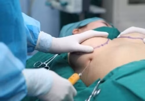 Nâng ngực không phẫu thuật bằng filler. Khác với các phương pháp thông thường khác nâng ngực không cần phẫu thuật bằng filler có sử dụng chất liệu nâng ngực như túi độn hay túi gel nâng ngực, hoặc các phương pháp nâng ngực phẫu thuật thông thường khác, nâng ngực bằng filler là cách đưa chất lỏng qua một đầu kim siêu nhỏ ,không gây đau đau đớn ,không cần gây mê ,không để lại sẹo và bạn có thể phục hồi sinh hoạt bình thường sau khi thủ tục kết thúc. Tùy thuộc vào độ hấp thu của cơ thể đối cũng như tái tạo tổ chức liên kết chỗ tiêm Filler mà có thể được tiêm bổ sung khi chất mà thể tích chất độn bị giảm ảnh hưởng đên vẻ đẹp bạn ao ước.