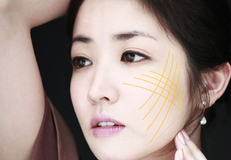 Sau khi sợi chỉ được cấy dưới bề mặt da sẽ dẫn đến sự hình thành collagen, tạo thành một mạng lưới collagen mới nâng đỡ cấu trúc da đã bị đứt gãy và tăng lưu lượng máu nuôi dưỡng, giúp làn da bạn được trẻ hóa một cách rõ rệt. Áp lực của chỉ tạo ra hiệu quả nâng cơ, giúp thon gọn mặt.