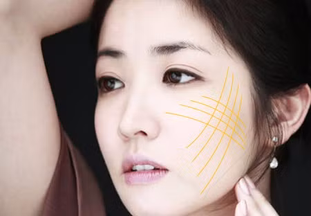 Sau khi sợi chỉ được cấy dưới bề mặt da sẽ dẫn đến sự hình thành collagen, tạo thành một mạng lưới collagen mới nâng đỡ cấu trúc da đã bị đứt gãy và tăng lưu lượng máu nuôi dưỡng, giúp làn da bạn được trẻ hóa một cách rõ rệt. Áp lực của chỉ tạo ra hiệu quả nâng cơ, giúp thon gọn mặt.