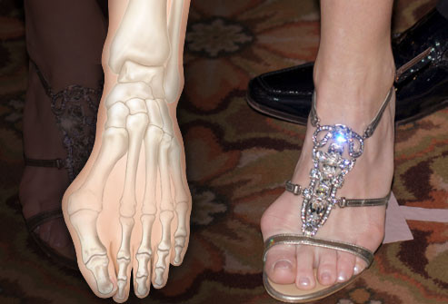 Giày cao gót cũng đẩy chân người đi về phía trước, làm các ngón chân xoắn vào với nhau khiến móng chân mọc vào trong, chai da, xước và tổn thương ngón chân.