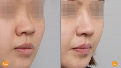 Hình ảnh trước và sau khi nâng mũi bằng phương pháp không phẫu thuật.
