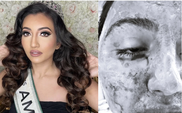 Điều ít ai biết, Á hậu Miss World 2021 từng bị biến dạng gương mặt Dieu it ai biet, A hau Miss World 2021 tung bi bien dang guong mat