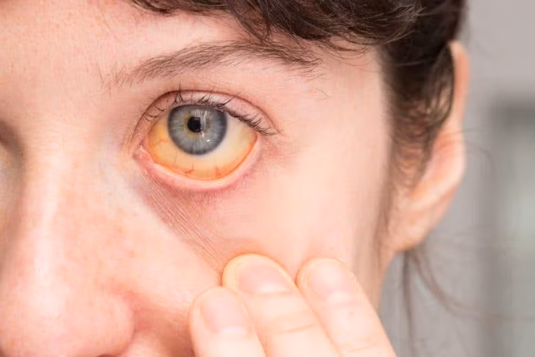 4 dau hieu bat thuong vao buoi sang cho thay xo gan, K gan den rat gan