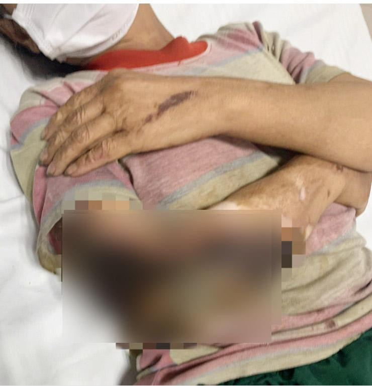 Nhiễm trùng nặng do chữa bỏng bằng cách nhiều người thường làm Nhiem trung nang do chua bong bang cach nhieu nguoi thuong lam