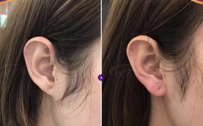 Tai trắng và mỏng như tờ giấy. Người có nét tướng này cuộc sống mãi nghèo khổ, vất vả. Tai trắng và mỏng là người có tâm địa độc ác, bạo lực, ngang ngược. Đây là người thường xảo quyệt, hay nịnh bợ, lẻo mép bị mọi người ghét bỏ, khó tránh lúc cuộc sống đơn độc, nghèo túng.