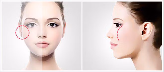  Xương gò má cao: Phụ nữ có gò má cao thường tính cách mạnh mẽ, phóng khoáng, sống độc lập tự chủ. Họ là những người tài giỏi, cũng ưa tự do, hiếm khi chịu sự ràng buộc của gia đình, càng không thích bị hôn nhân bó buộc. 