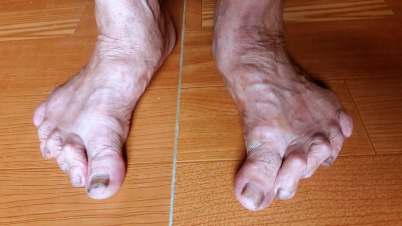 Theo các chuyên gia khảo cổ học, dù giải thích theo trường hợp này thì kiểu ngón chân có dạng giao nhau này đều là do bệnh lý chứ không phải là nét đặc trưng của người Việt cổ. Ảnh: Đời sống &amp; Pháp lý.