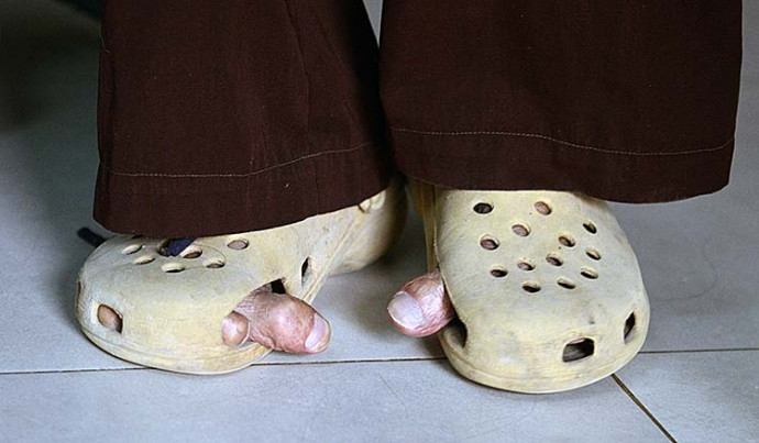 Đây có thể coi là một hiện tượng bệnh lý mang tính di truyền hiếm gặp, thường tự nhiên xuất hiện và sẽ mất sau 1-2 thế hệ. Ảnh: Báo Giao Thông.