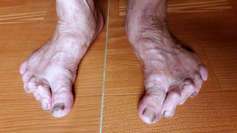 Theo PGS Hà Văn Phùng, Viện trưởng Viện khảo cổ học, dù giải thích theo trường hợp này thì kiểu ngón chân có dạng giao nhau này đều là do bệnh lý chứ không phải là nét đặc trưng của người Việt cổ. Ảnh: Đời sống &amp; Pháp lý.