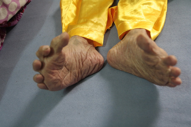 Có một số cách lý giải về bàn chân đặc biệt này. Thứ nhất, dân tộc ta là một dân tộc làm nông nghiệp, người nông dân thường xuyên đi chân đất để làm đồng thuận tiện. Khi lội bùn, ngón cái phải choãi ra để giữ thăng bằng, tránh bị ngã, lâu ngày làm thay đổi cấu trúc xương. Ảnh: GĐ &amp; XH.