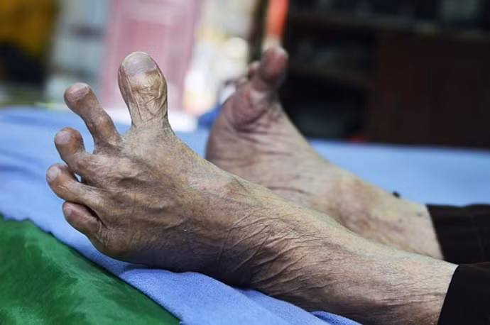 Chế độ ăn không đủ dinh dưỡng, chế độ sinh hoạt thiếu canxi thời xưa là nguyên nhân khiến cho xương dễ bị biến dạng. Ảnh: Báo Giao Thông.