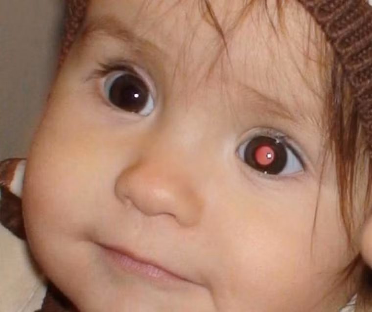 Ngoài những dấu hiệu cụ thể nhận diện khối u trên, bạn cũng không nên bỏ qua các triệu chứng của ung thư mắt như: