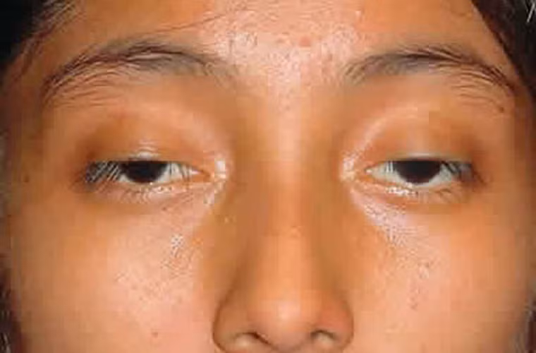 Việc phát hiện các dấu hiệu ung thư sớm đóng vai trò quan trọng trong nỗ lực nâng cao hiệu quả điều trị bệnh. Một trong những dấu hiệu bạn có thể nhận biết dễ dàng là tầm nhìn của bạn bị hạn chế.