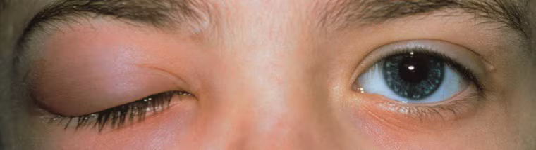 Vùng mí mắt sưng lên. Nếu nghiêm trọng, sẽ xuất hiện các vết lở loét.