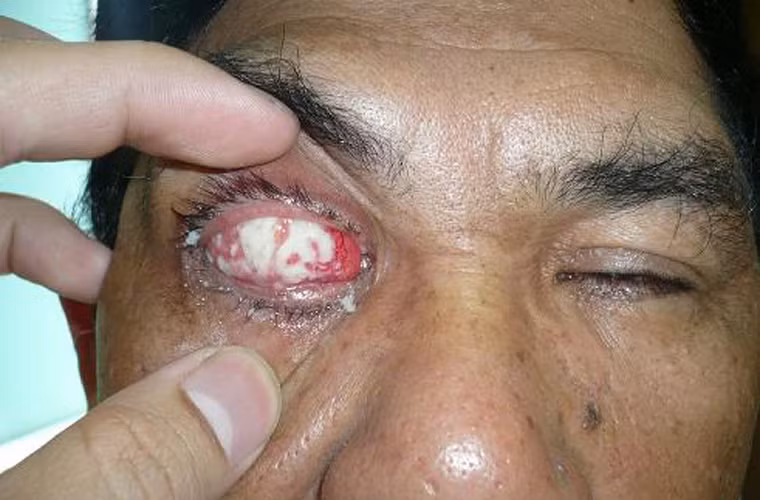 Sự xuất hiện khối u ở trong mắt khiến khả năng nhìn xa bị giảm đáng kể. Ngoài ra, một số trường hợp khối u còn tạo ra các “hạt” nhỏ nổi lên ở mắt hay các vết hằn, tụ máu.