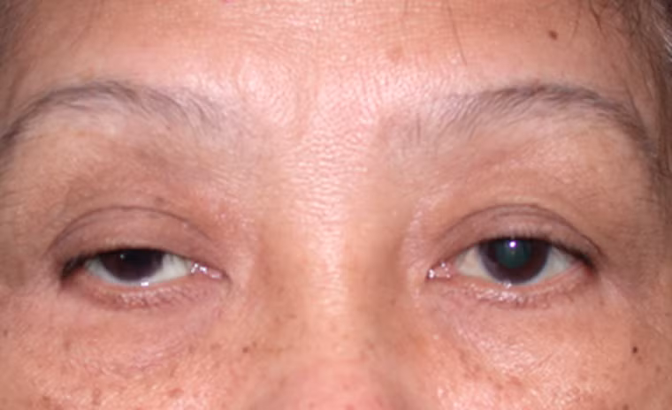 Hai mắt không cân đối hoặc có triệu chứng nhìn nghiêng.