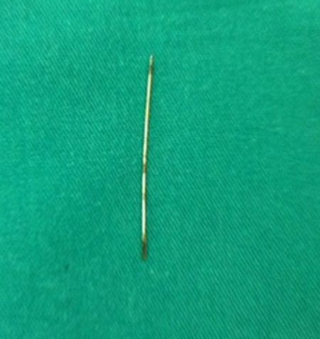 Cây kim saun khi được lấy ra. Ảnh: BSCC