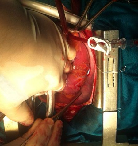 Mổ tim hở cấp cứu bệnh nhân bị kim đâm thấu tim. Ảnh: BSCC