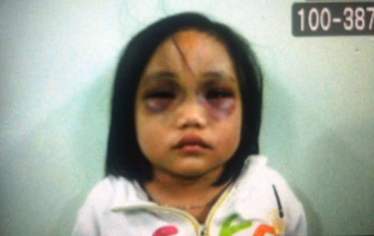 Hình ành bé Thùy Dương bị bầm tím 2 mắt và thương tích đầy người vì bị cha đánh đập tàn nhẫn lúc vừa được UBND, Công an phường Hiệp Bình Phước giải cứu.