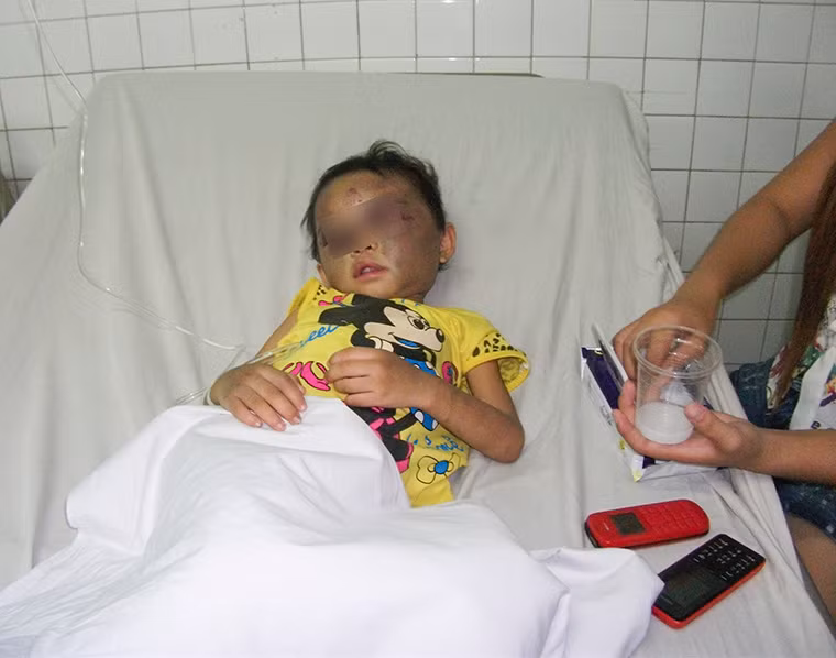 Bé Ng. đang được điều trị tại bệnh viện đa khoa Bình Dương trong tình trạng bị tím bầm 2 mắt, chấn thương sọ não.