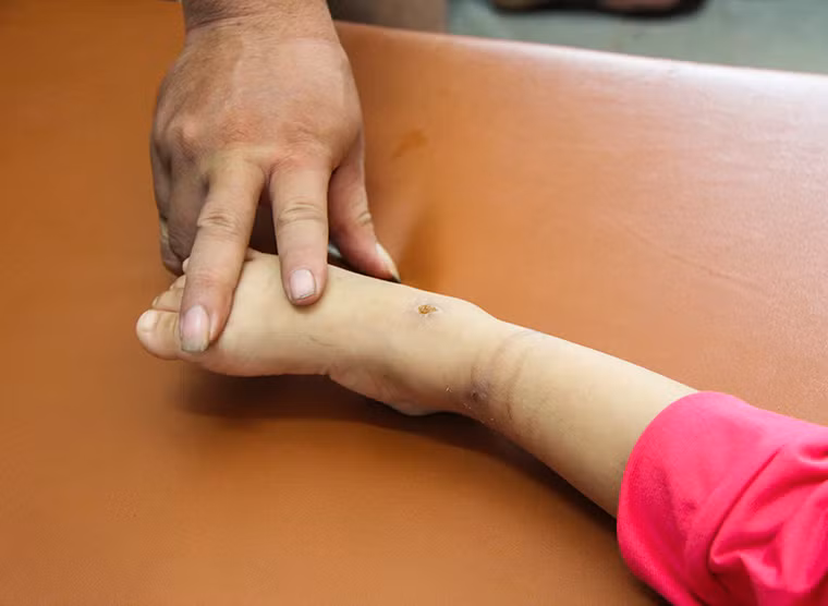 Vết thương chi chít trên tay, chân bé