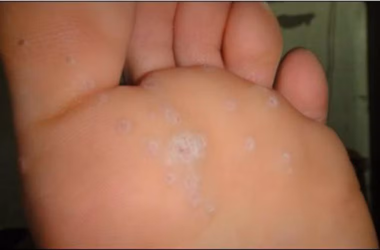 Có thể trị nấm chân. Do muối có tác dụng khử trùng, kháng khuẩn rất tốt, khi cho muối ăn vào nước nóng tận dụng hơi nóng của nước thì da càng dễ hấp thụ các thành phần khử trùng, kháng khuẩn trong nước muối, có tác dụng điều trị nấm chân.