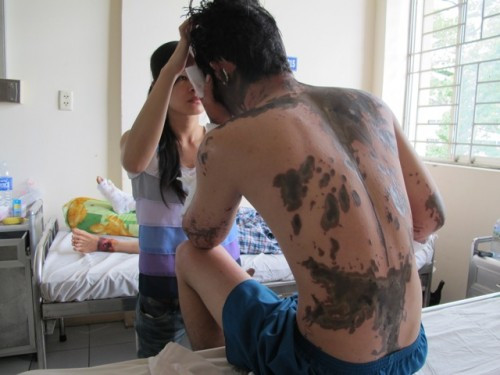 Những vết bỏng trên lưng và trên mặt của anh B bị đối tượng Cường và Hương tạt axit.