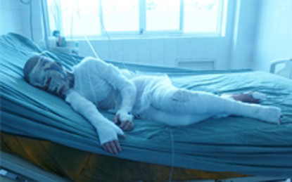 Bé Quỳnh Trang, con của anh Đại bị bỏng toàn thân vì axit và phải nằm ở phòng cách ly.