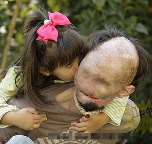 Dù khuôn mặt của cha bị biến dạng vì điện giật, nhưng cô bé Scarlette vẫn hôn lên khuôn mặt và yêu quý người cha của mình. Bức ảnh được hàng nghìn cư dân mạng chia sẻ nhau xem với tốc độ chóng mặt.