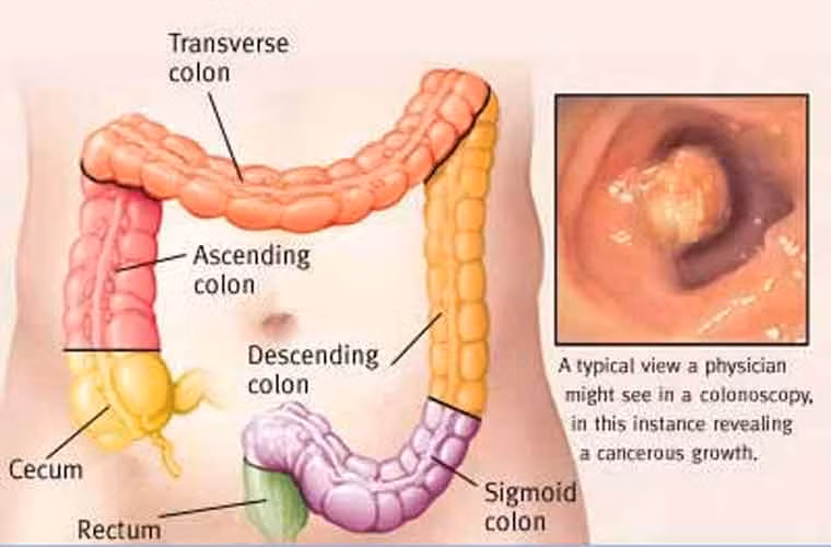  9. Ung thư đại trực tràng. Đây là loại ung thư phổ biến thứ hai ở phụ nữ, cứ 15 người thì có 1 người có nguy cơ mắc bệnh này khi 85 tuổi. Tuổi cao, viêm nhiễm đường ruột, béo phì và hút thuốc là những tác nhân dễ dẫn tới ung thư đại - trực tràng. Việc siêu âm nên được tiến hành từ khi 55 tuổi. Chế độ ăn uống hợp lý và tập luyện thể thao có thể phòng ngừa tới 75% khả năng mắc bệnh này .