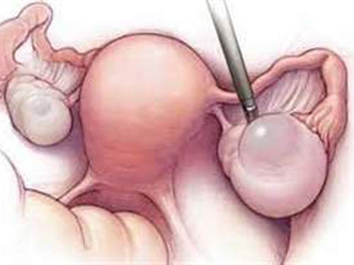 9. Buồng trứng. Nguyên nhân dẫn đến phát bệnh có nhiều mặt, ví dụ như thức đêm dẫn đến rối loạn nội tiết, quan hệ tình dục quá sớm,… 