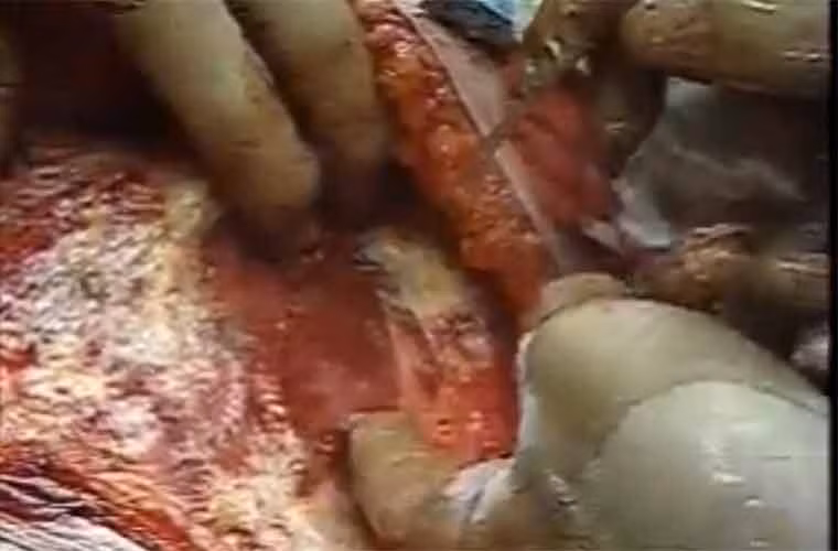 ... tiếp đó là xác định khối u...