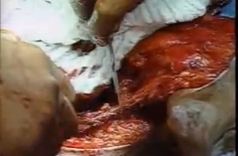 Khối u đang được cắt bỏ.