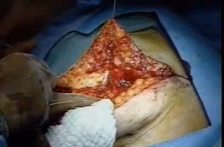 ... mở rộng vết mổ...