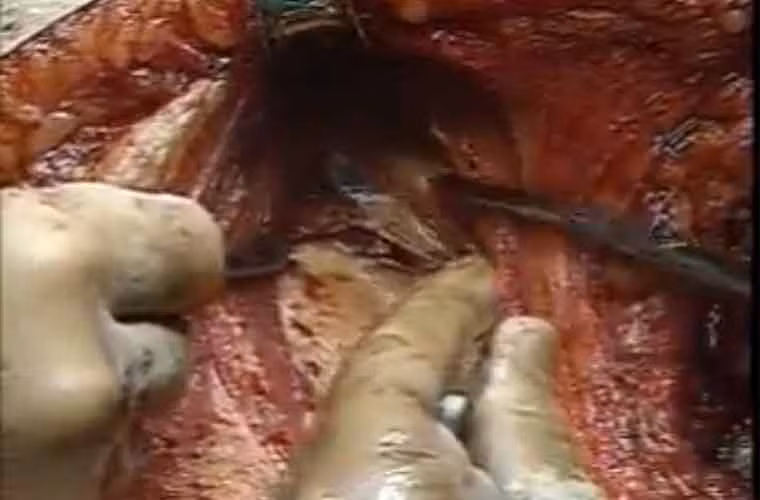 ... rồi tiến hành cắt khối u.