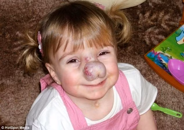 Vết bớt trên mũi cô bé được cho là bị gây ra bởi một mặt nạ dưỡng khí quá chặt. Nó đã phát triển nhanh chóng làm hư hỏng mũi của Zoe và khiến cho bé có nguy cơ bị nghẹt thở.