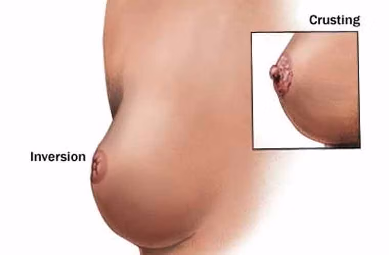 15. Sự thay đổi của núm vú. Một trong những thay đổi phổ biến được xem là dấu hiệu của ung thư vú mà hầu hết phụ nữ nên chú ý là núm vú bắt đầu trở nên phẳng lì, thụt vào bên trong, hoặc lệch sang một bên. Ngoài ra, ung thư vú cũng gây ra vấn đề núm vú, chẳng hạn như ngứa, có vảy, hoặc da giòn trên núm vú…