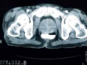 Các nhà khoa học Canada đang nghiên cứu phương pháp phát hiện ung thư qua cách xác định âm thanh của tế bào ung thư trong máu thông qua một thiết bị hiển vi kết hợp công nghệ siêu âm và laser.