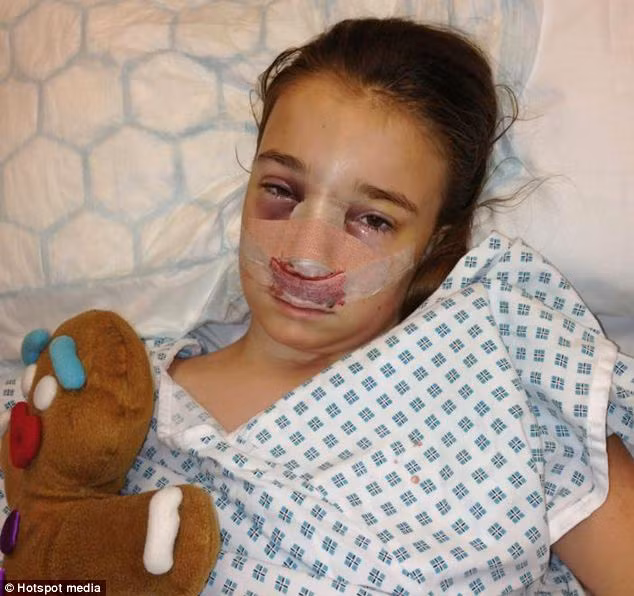 Zoe cũng có nguy cơ bị mất thị lực khi mà khối u ngày càng lớn hơn, lan rộng toàn bộ mũi của bé khi cô bé chỉ mới 7 tuần tuổi. Cô bé đáng thương đã phải trải một đợt hóa trị kéo dài 12 tháng cũng như phẫu thuật để loại bỏ khối u ở mũi khi được 4 tuổi.