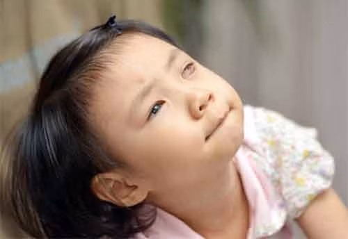 U nguyên bào võng mạc là một bệnh ung thư phát triển nhanh chóng trong các tế bào của võng mạc, ánh sáng xuất hiện ở mô mắt. Trong tất cả các trường hợp bị bệnh này thì chỉ có 1/3 khối u phát triển trong cả hai mắt (retinoblastoma bilateral). Trong khi đó, có khoảng 2/3 trường hợp có một mắt bị ảnh hưởng (nguyên bào võng mạc đơn).