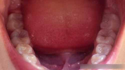 Vi khuẩn Fusobacterium nucleatum (Fn), thường gặp nhiều ở những người bị bệnh nướu răng, có thể gây ung thư ruột kết.