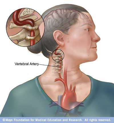 Đứng thứ 2 là đột qụy. Đột qụy không chỉ có thể dẫn đến tử vong mà còn làm cho phụ nữ bị tàn tật và mất khả năng chăm sóc gia đình. Đột quỵ là biến chứng của bệnh tim mạch, gây ra 8% số các ca tử vong, nhất là ở phụ nữ cao tuổi. Đột quỵ xảy ra khi dòng máu cung cấp cho một phần của não bộ bị tắc nghẽn hoặc mạch máu bị vỡ. Đột quỵ có thể dẫn đến tử vong hoặc những tổn thương não, chứng liệt và các vấn đề về ngôn ngữ.