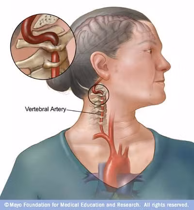 Đứng thứ 2 là đột qụy. Đột qụy không chỉ có thể dẫn đến tử vong mà còn làm cho phụ nữ bị tàn tật và mất khả năng chăm sóc gia đình. Đột quỵ là biến chứng của bệnh tim mạch, gây ra 8% số các ca tử vong, nhất là ở phụ nữ cao tuổi. Đột quỵ xảy ra khi dòng máu cung cấp cho một phần của não bộ bị tắc nghẽn hoặc mạch máu bị vỡ. Đột quỵ có thể dẫn đến tử vong hoặc những tổn thương não, chứng liệt và các vấn đề về ngôn ngữ.