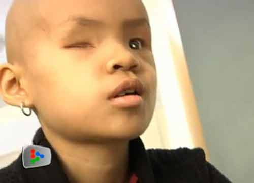 Vào tháng 6 năm ngoái, tình trạng của Zixuan đã ổn định, chị Pan quyết định bay trở lại Singapore.Tuy nhiên, trong vòng 5 tháng sau khi trở về nhà, mắt của Zixuan bị tái phát.Các tế bào ung thư đột nhiên lại tái phát, buộc các bác sĩ phải loại bỏ những gì còn lại của mắt trái của cô bé - dẫn đến mù lòa vĩnh viễn.