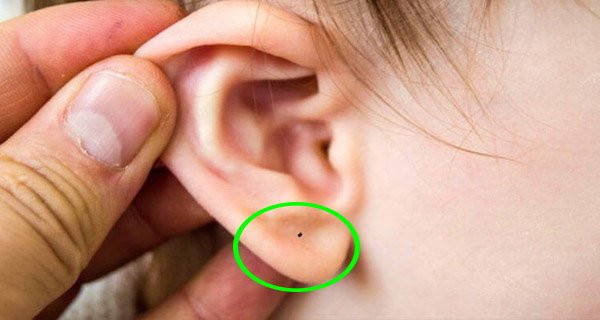 Tre co 1 trong 6 not ruoi nay la phuoc bau, tuong lai sang nhu ngoc-Hinh-2