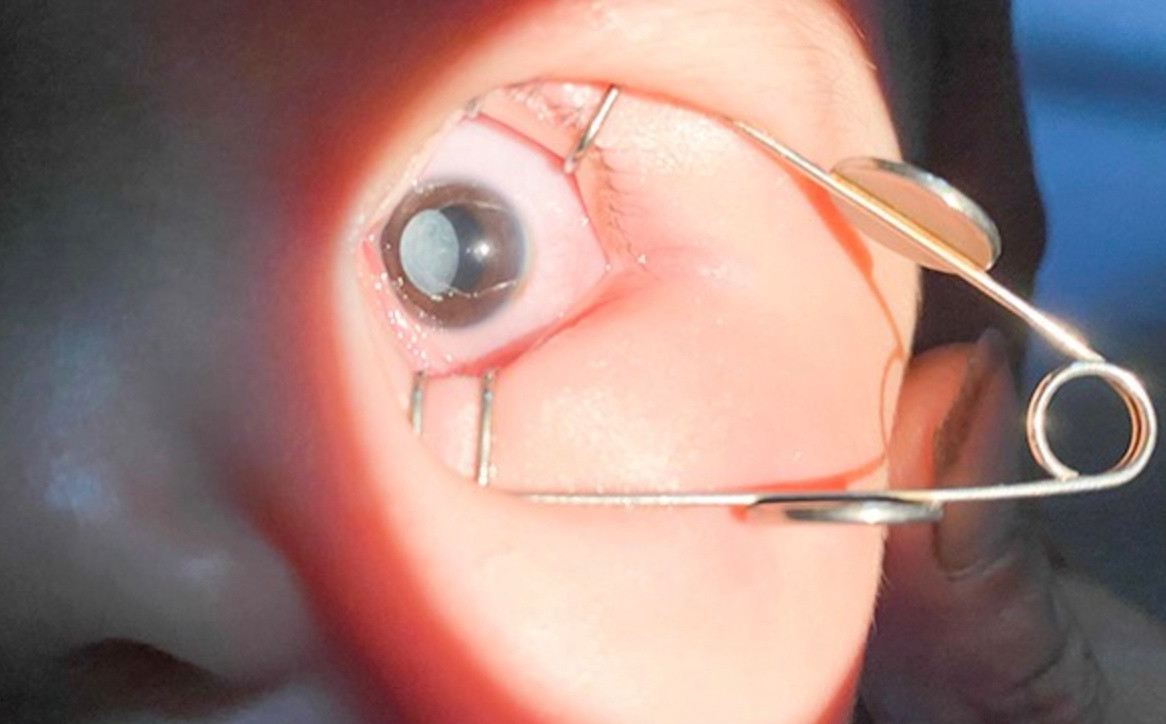 Nguy co mu vinh vien o tre sinh non