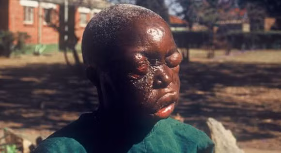 Một khuôn mặt bị tàn phá bởi vi rút Ebola.